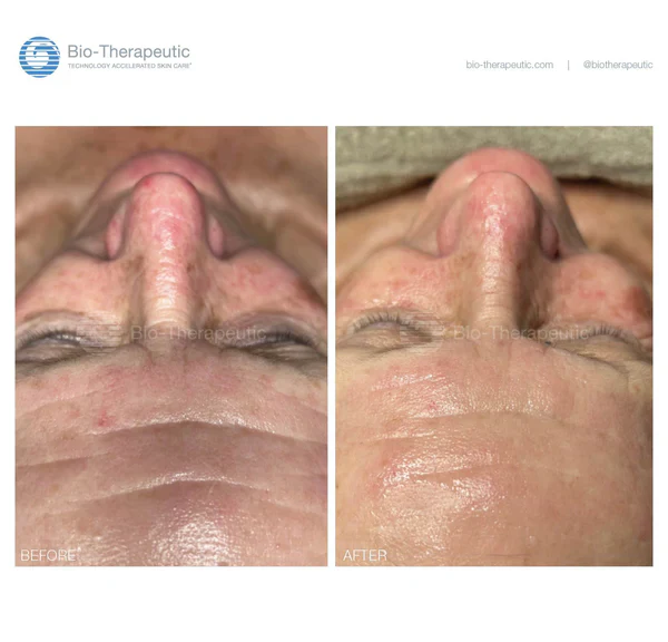 BT-BEFOREANDAFTER-ALL-WEB-REV06252524_bbb2dfc1-6cf5-480a-9e34-f57ecd059d40 microcurrent facial device,facial toning device,at home microcurrent,facial sculpting device,Bio-Therapeutic microcurrent,handheld facial device,EMS facial toning,facial lifting device,professional microcurrent device,skin firming device,bt sculpt gen2,bt sculpt gen2 microcurrent facial lifting